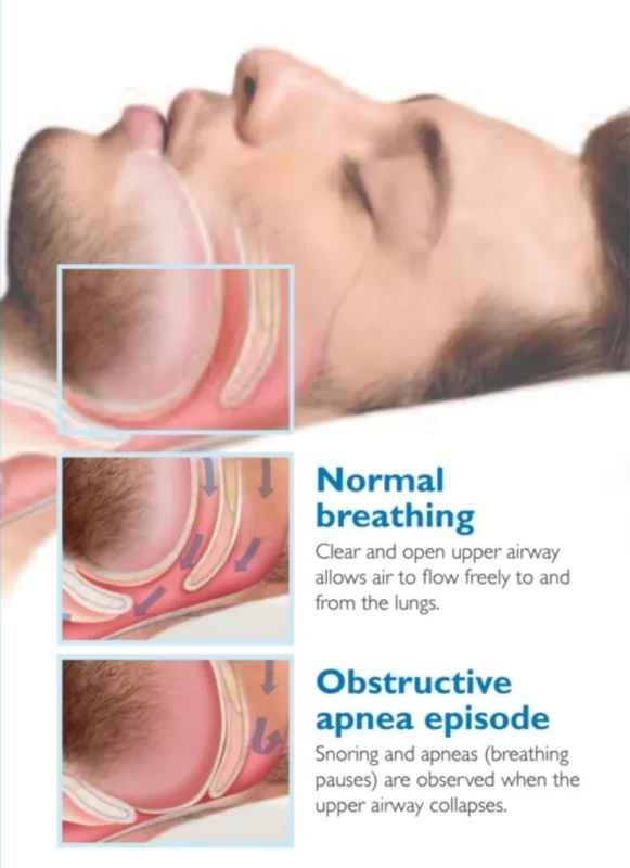 Sleep-Apnea